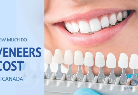 What are Dental Veneers and How Much Do They Cost in Canada?