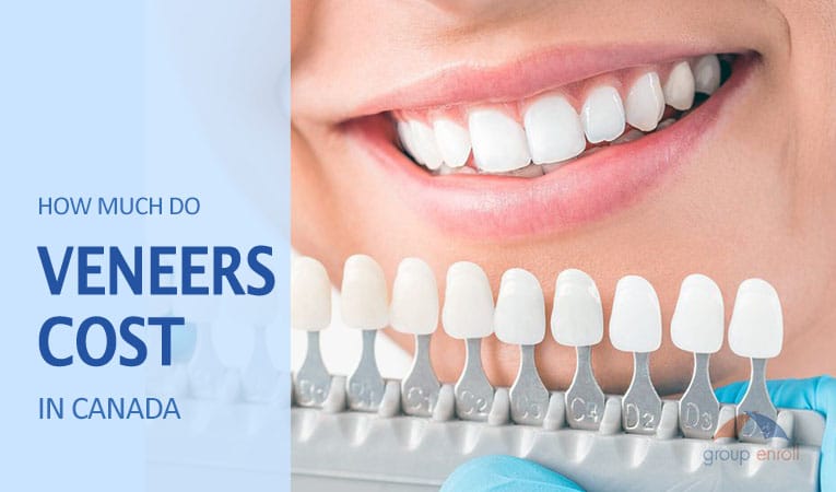 How Much Do Dental Veneers Cost In Canada Explained