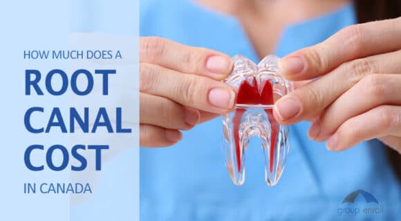 How Much Does a Root Canal Cost in Canada
