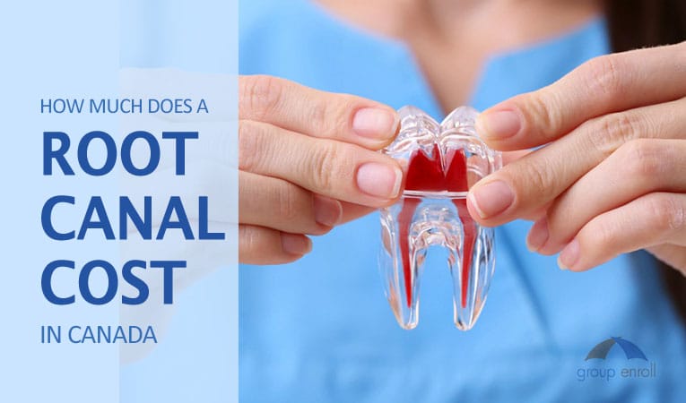 How Much Does a Root Canal Cost in Canada