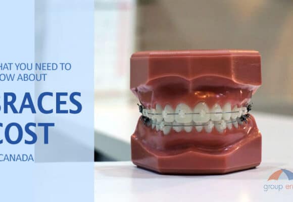 What you need to know about Braces Cost in Canada