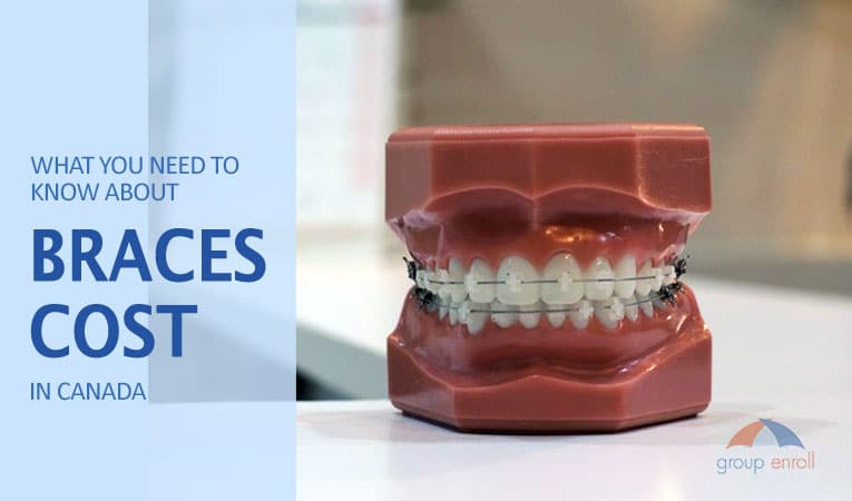 what you need to know about braces cost in canada by groupenroll watermark lowres