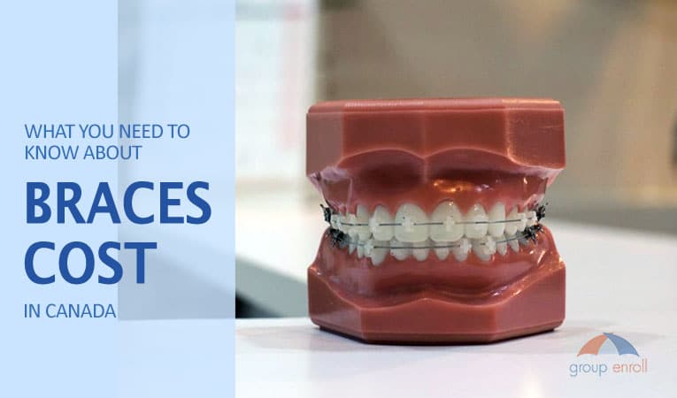 https://groupenroll.ca/wp-content/uploads/2020/08/what-you-need-to-know-about-braces-cost-in-canada-by-groupenroll-watermark-lowres.jpg